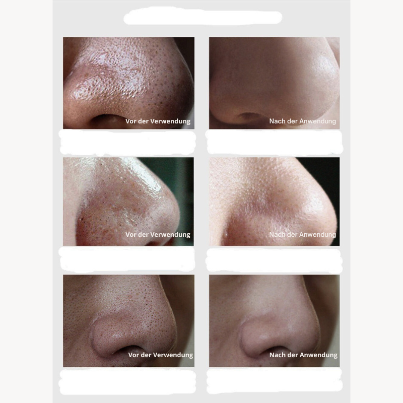 Lanbena™ | Für eine saubere und frische Haut!