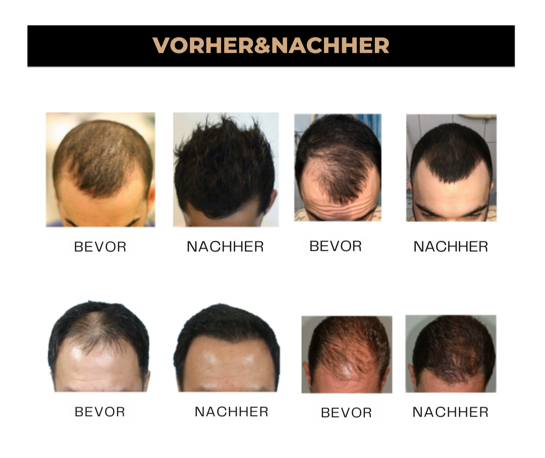 HairBoost™ | Keine kahlen Stellen mehr!