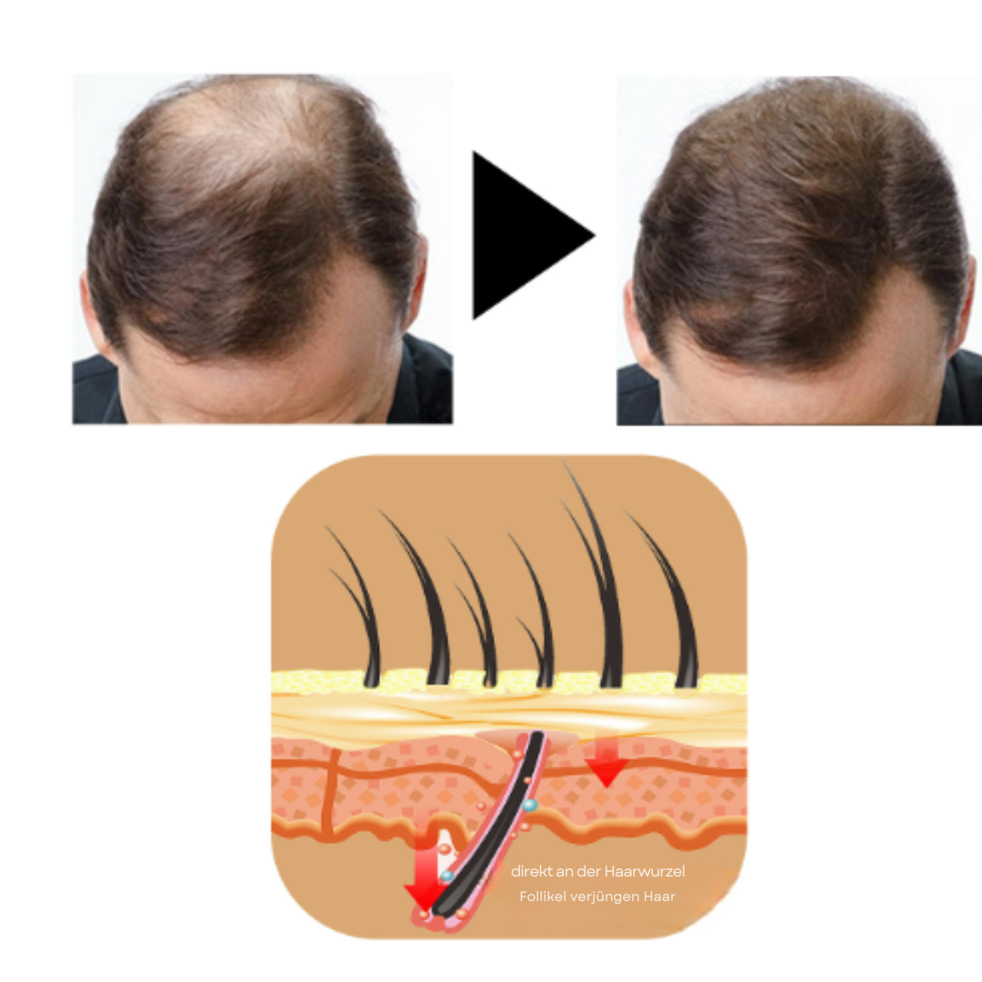 HairBoost™ | Keine kahlen Stellen mehr!